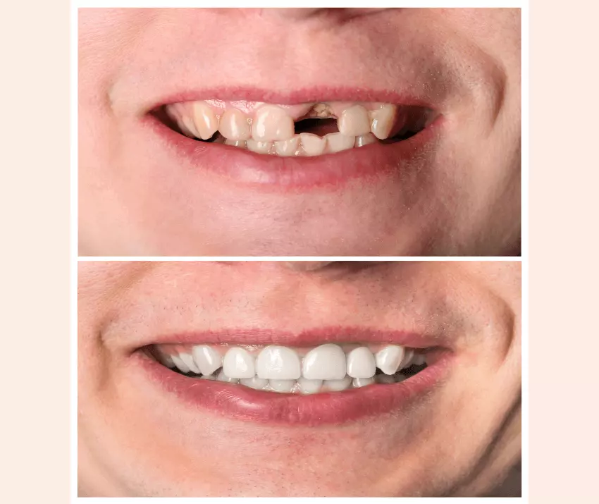 dental bridge - pre and post image