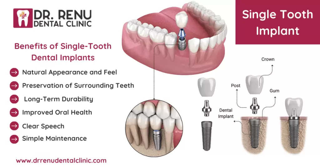 Single Tooth Dental Implants