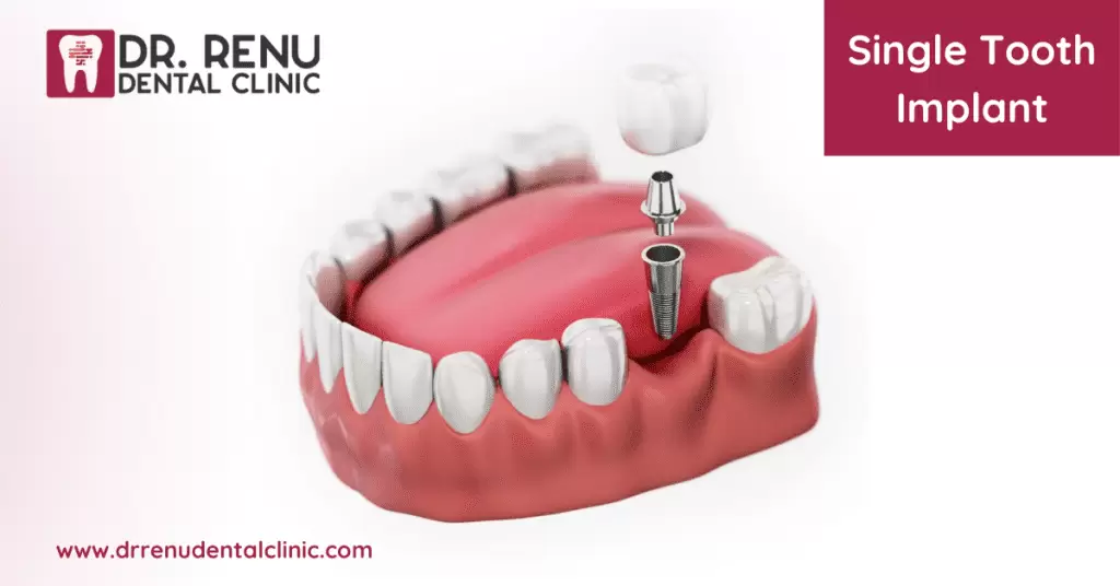 Single Tooth Dental Implants
