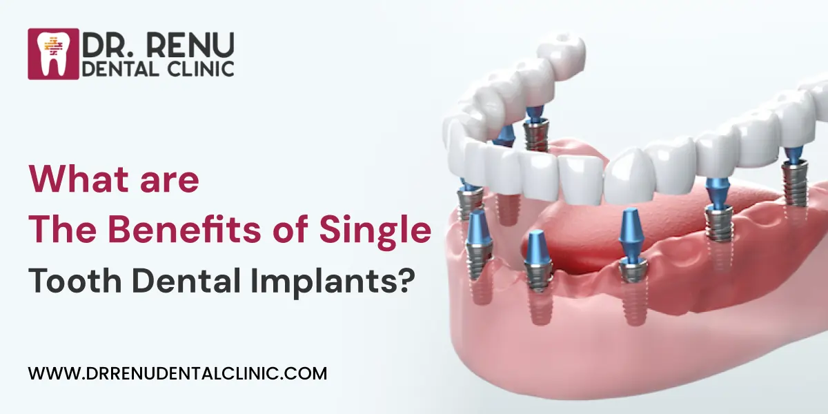 What are The Benefits of Single Tooth Dental Implants?