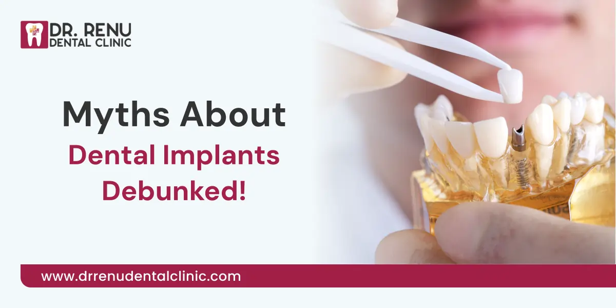 Debunking Common Myths About Dental Implants