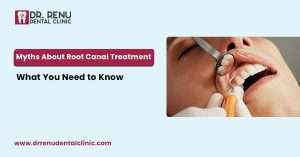 Myths About Root Canal Treatment: What You Need to Know