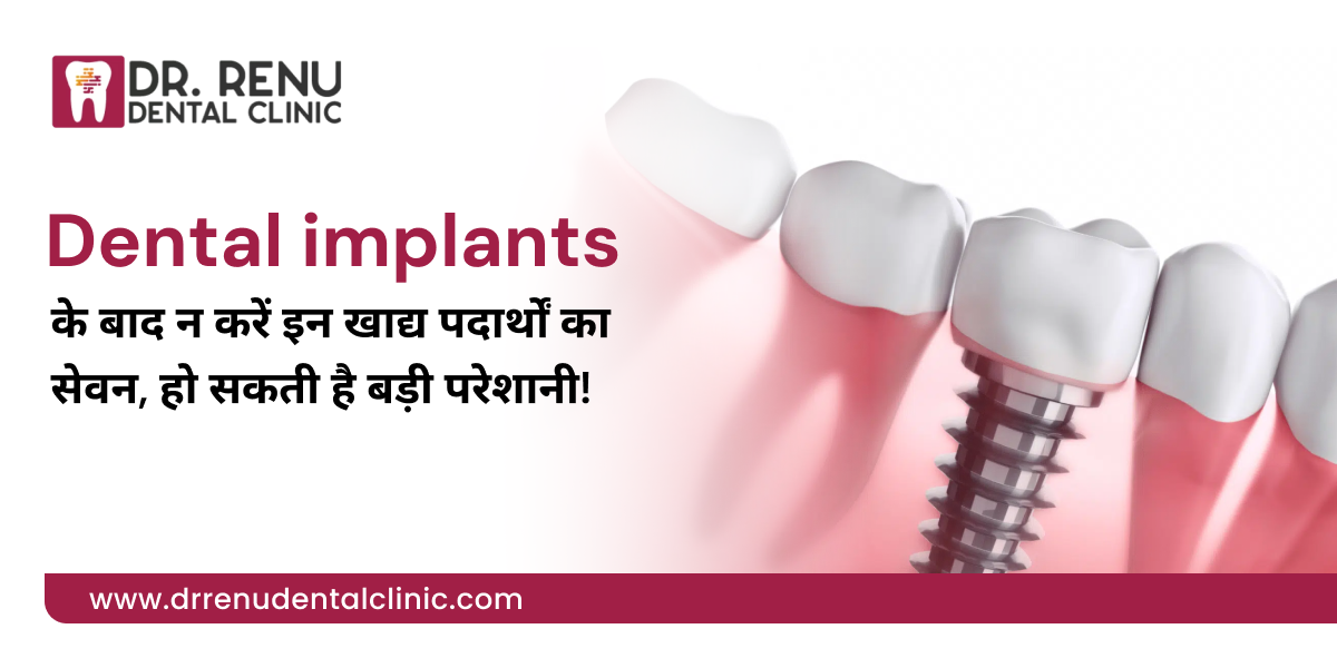 डेंटल इम्प्लांट्स के बाद न करें इन खाद्य पदार्थों का सेवन, हो सकती है बड़ी परेशानी!