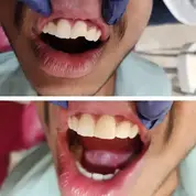 Composite Bonding 7