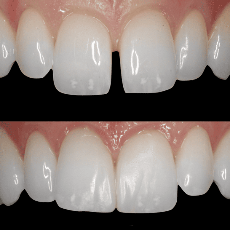 Composite Bonding
