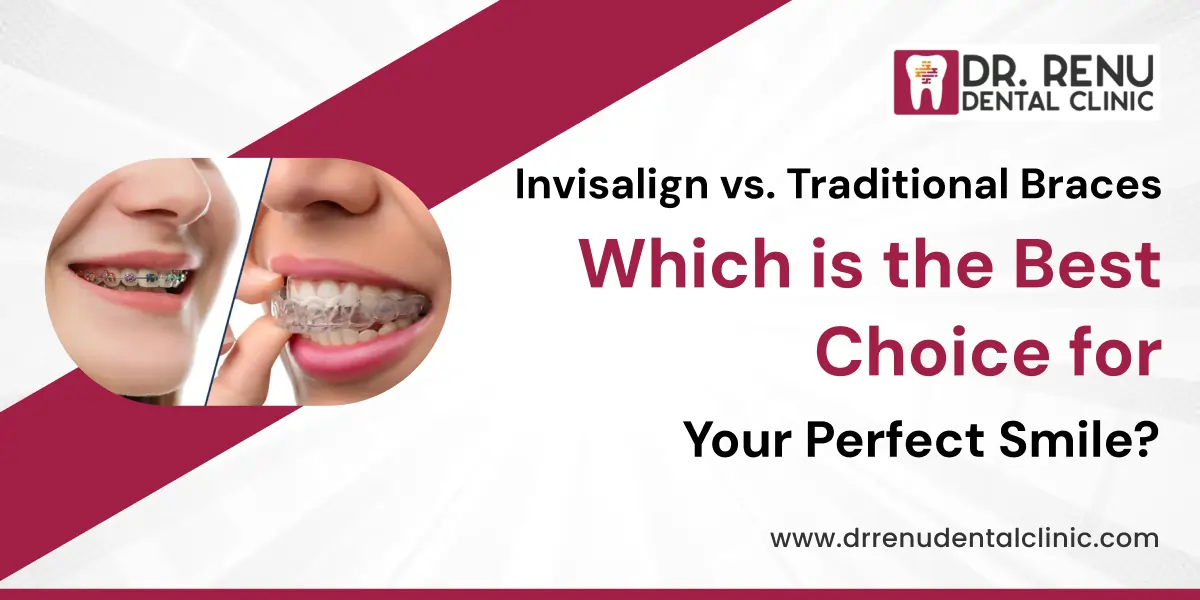 Invisalign vs. Traditional Braces: Which is the Best Choice for Your Perfect Smile?