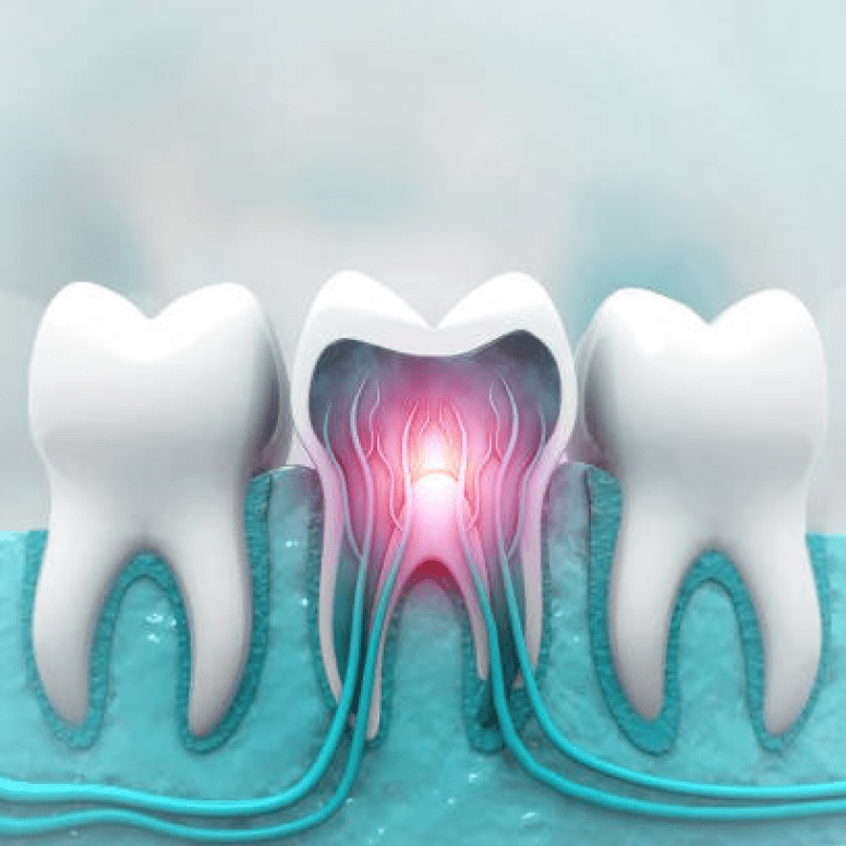 Sensitive Teeth Treatment