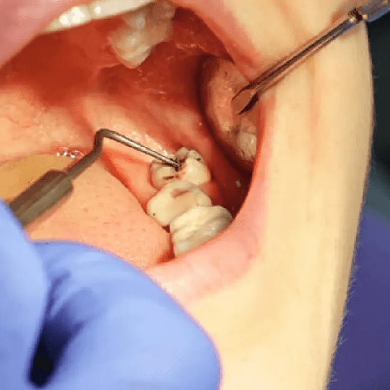 Wisdom Tooth Surgery