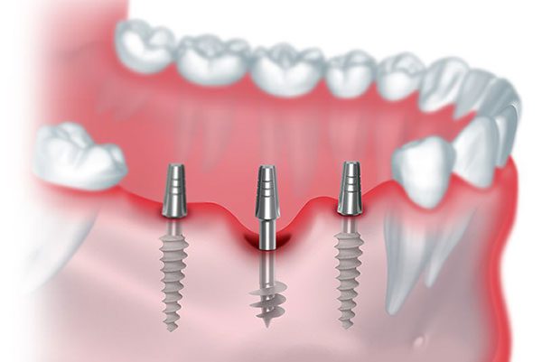 Basal Implants
