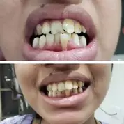 composite Bonding 4