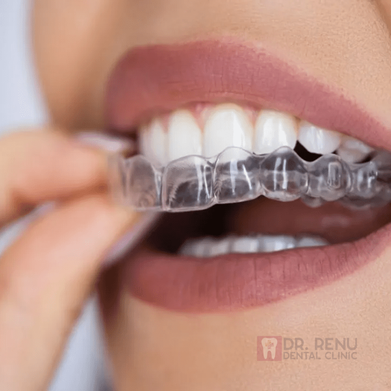 Invisible Aligners