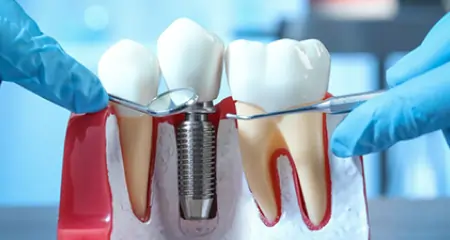 Dental Implant in nirman nagar