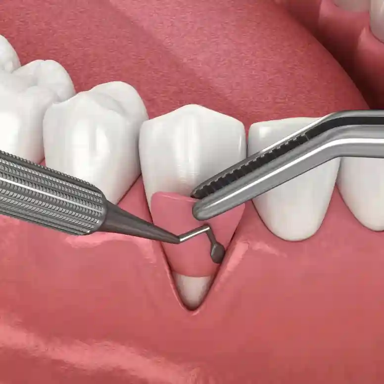 Gum-Surgery