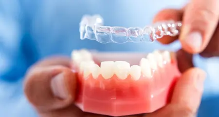 Invisible Aligners Treatment in Nirman Nagar