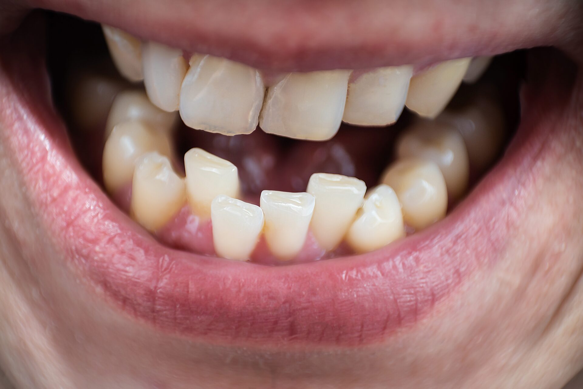 Misaligned-teeth