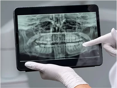 CBCT & OPG Scans – Precise Diagnosis