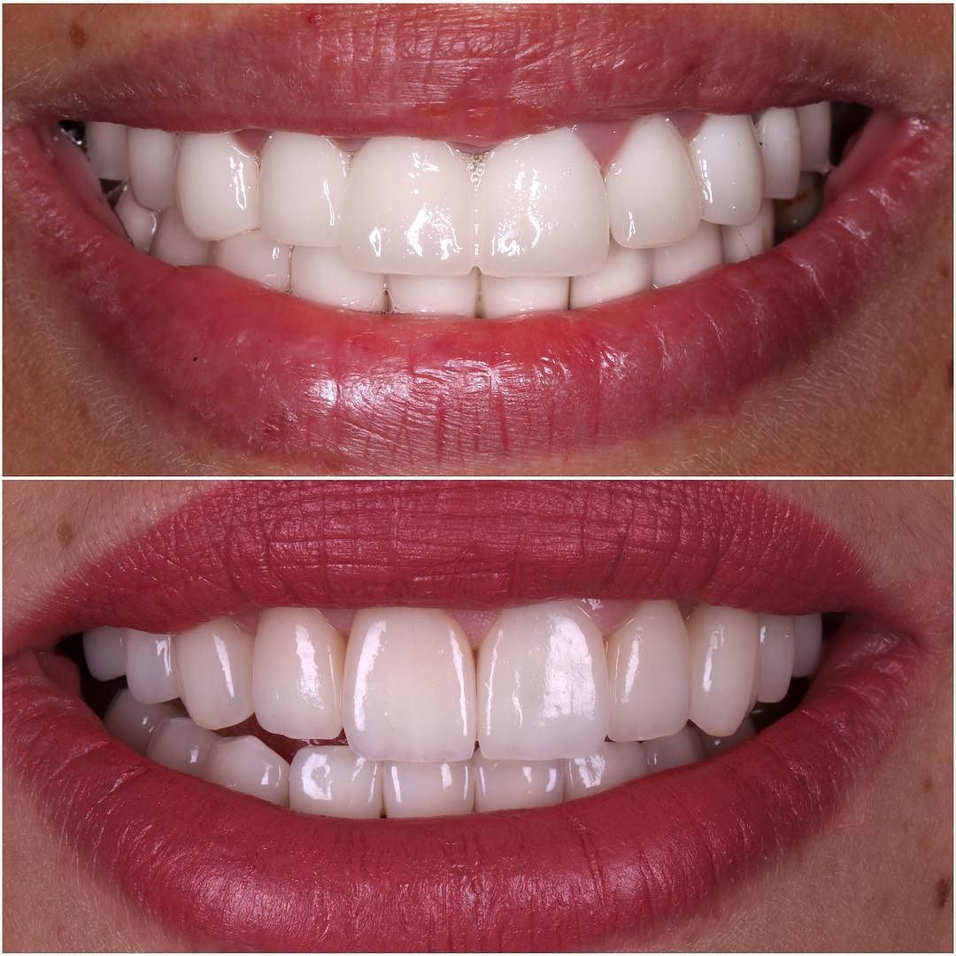 High-Strength Ceramic Materials (E-max/Zirconia)