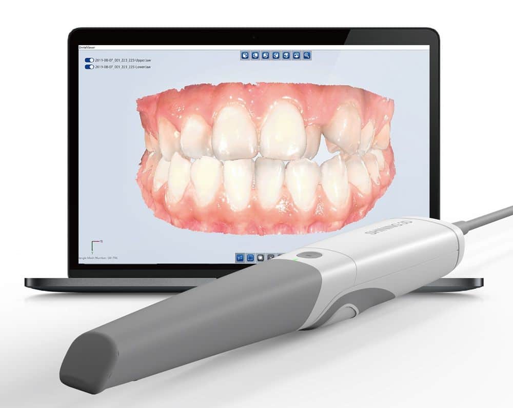 Intraoral 3D Optical Scanner