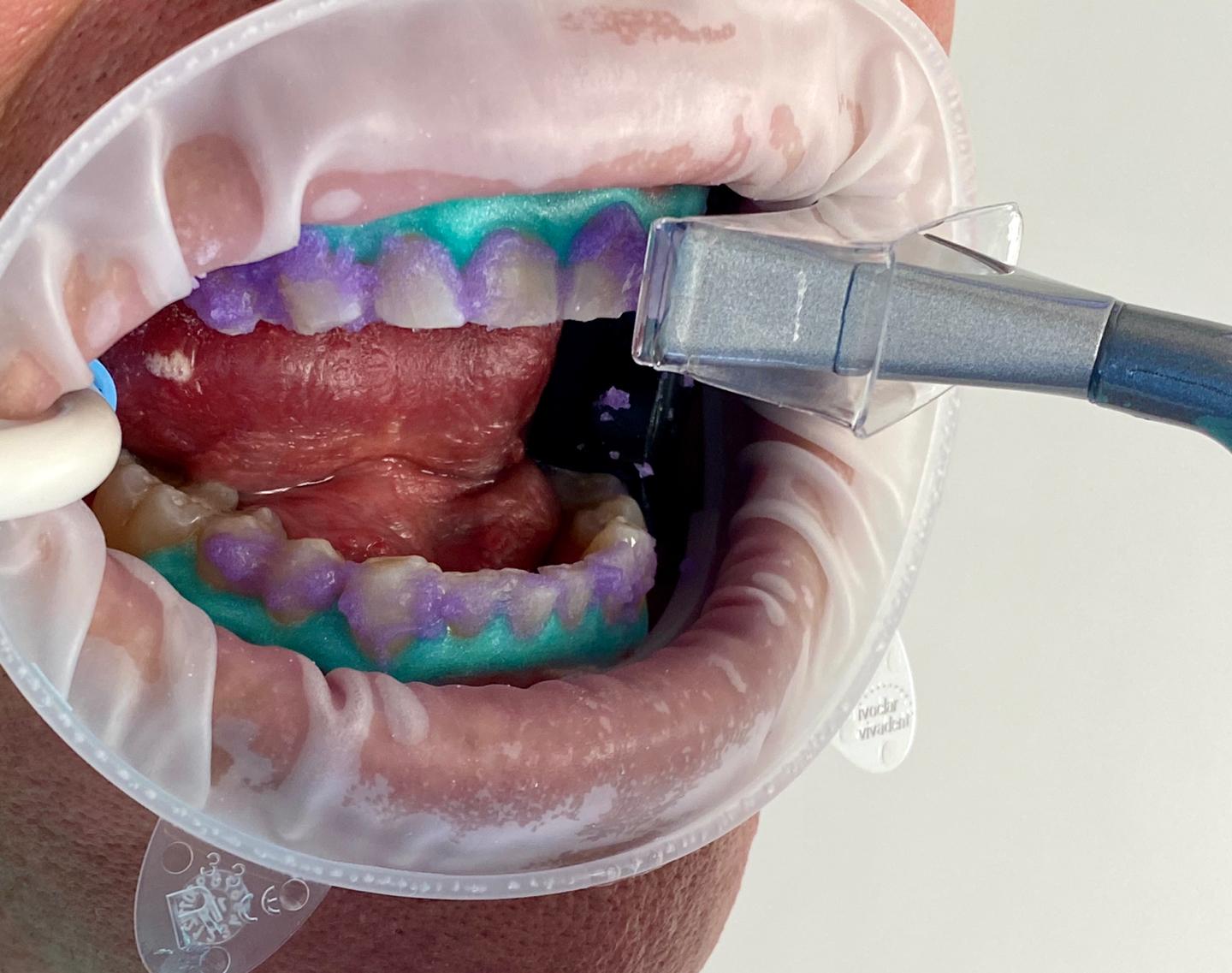 Laser Teeth Whitening System