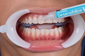Post-Whitening Desensitizing Technology
