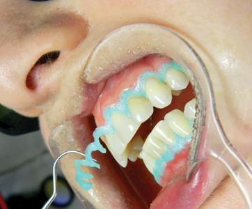 Power Bleaching Gel System