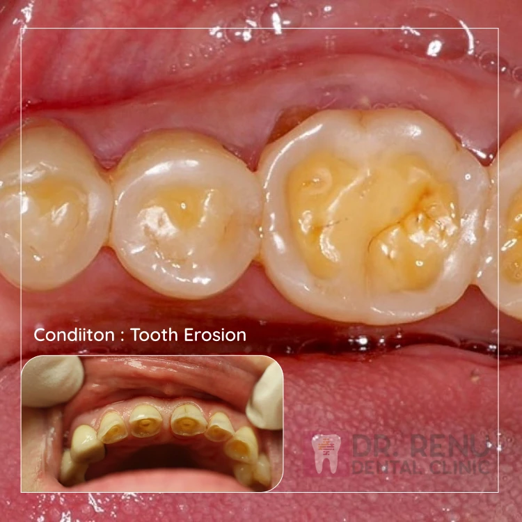 Tooth Erosion