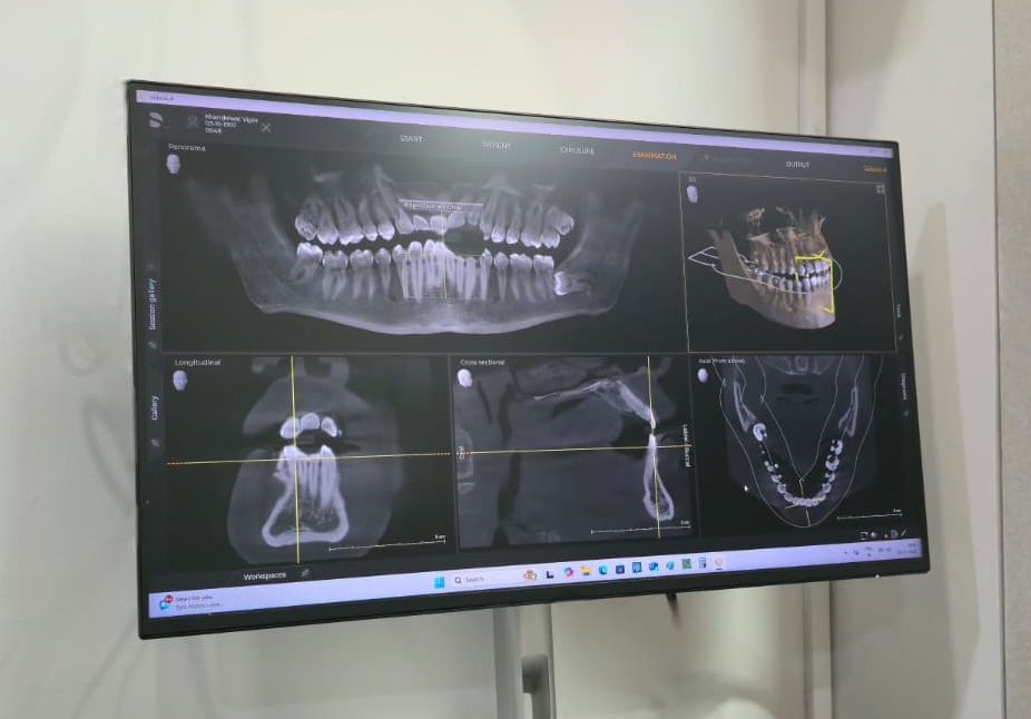 CBCT & OPG Scans for Accurate Diagnosis