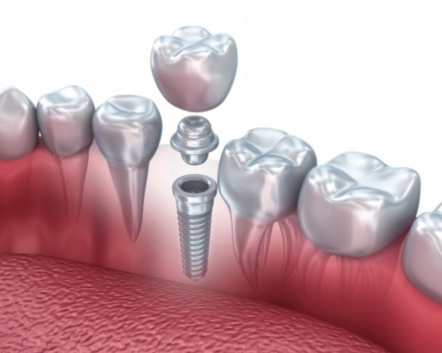 Safe for Braces & Implants