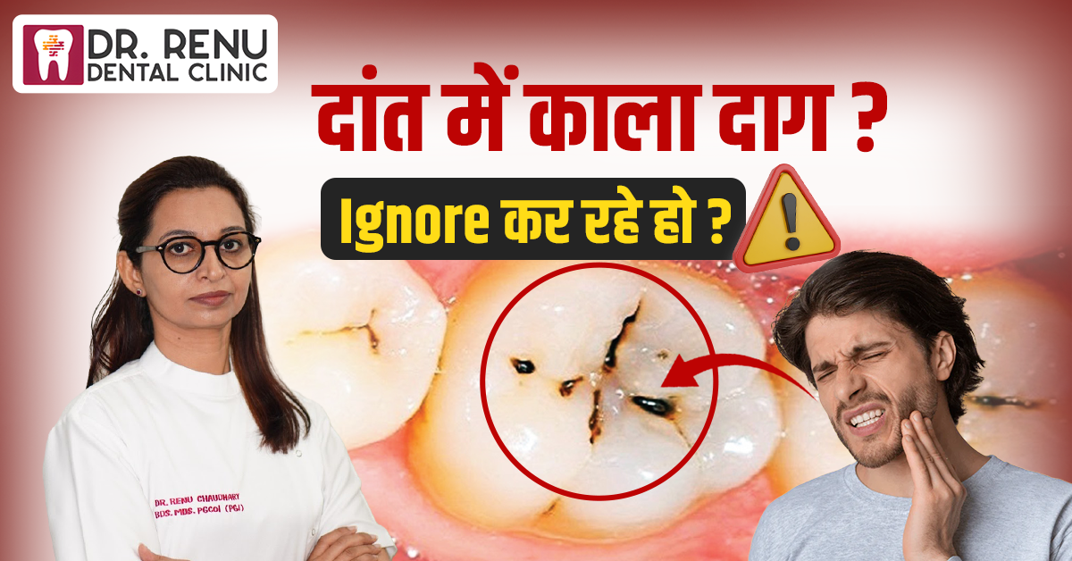 Black Spot on Teeth? Are you ignoring it?