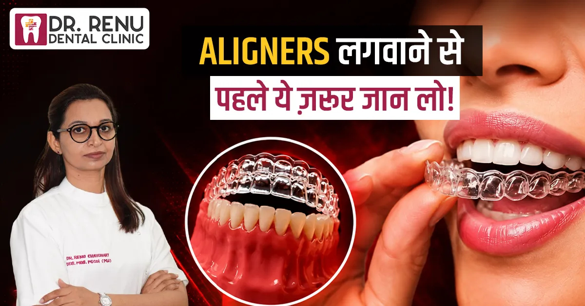 Aligners लगवाने से पहले ये ज़रूर जान लो! | Invisible Aligners Complete Guide