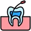 Hidden Root Canals
