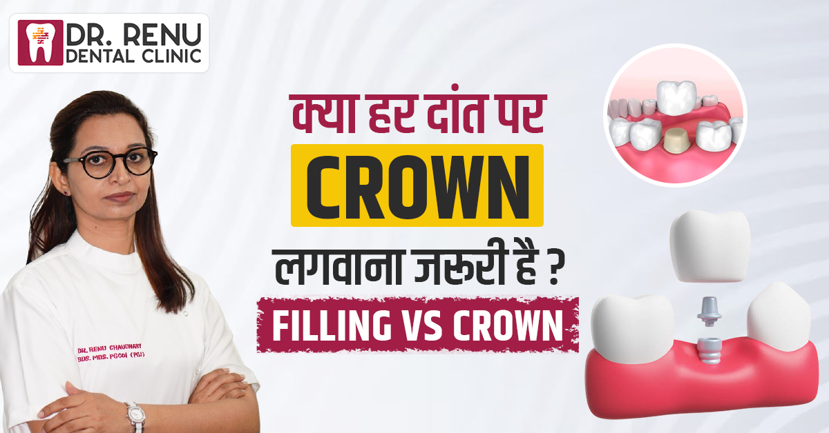 क्या हर दांत पर Crown लगवाना जरूरी है? Filling vs Crown | Digital Crown कैसे बनता है?