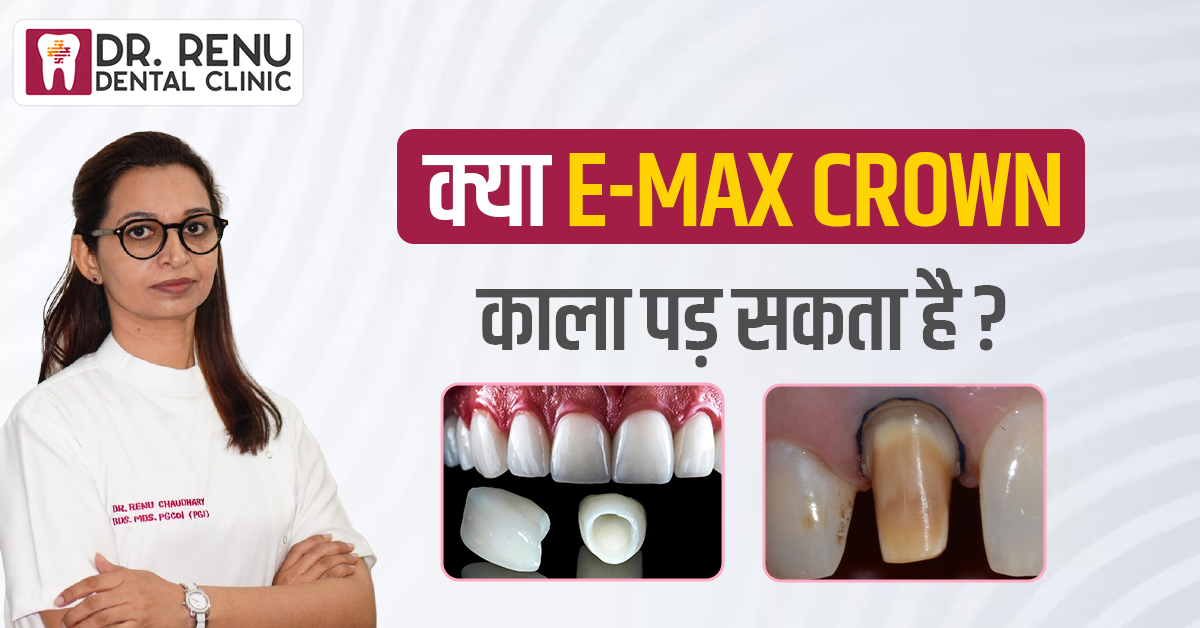 क्या E-max Crown काला पड़ सकता है? एक Real Patient Case Story