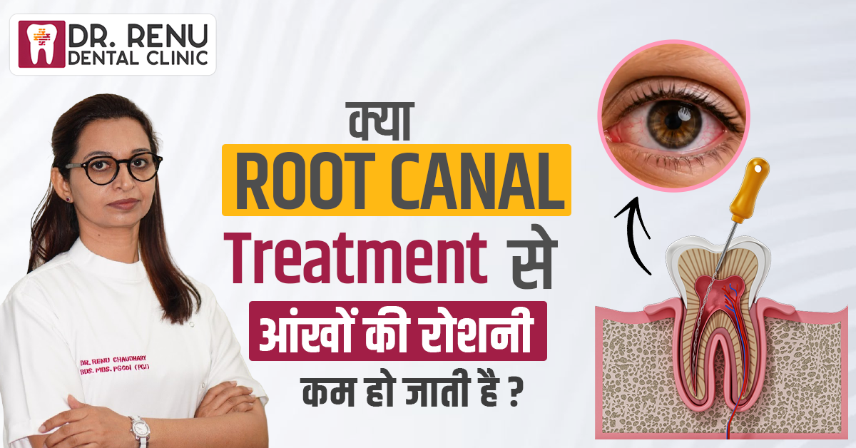 क्या Root Canal Treatment से आंखों की रोशनी कम हो जाती है? जानिए पूरी सच्चाई