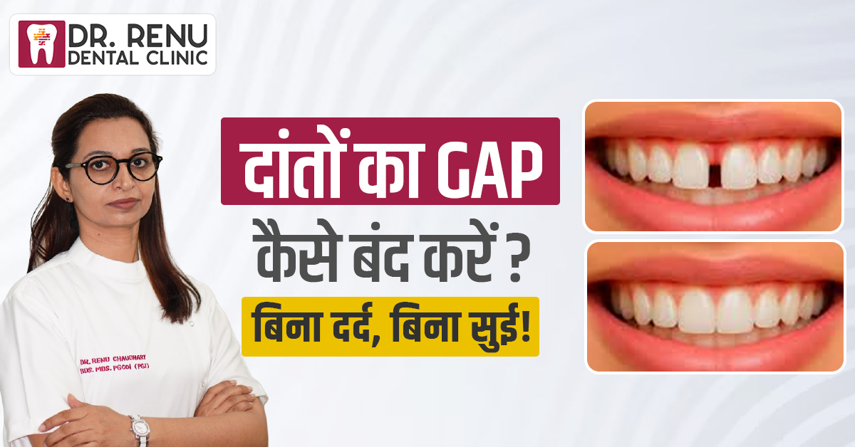दांतों का Gap कैसे बंद करें? बिना दर्द, बिना सुई!