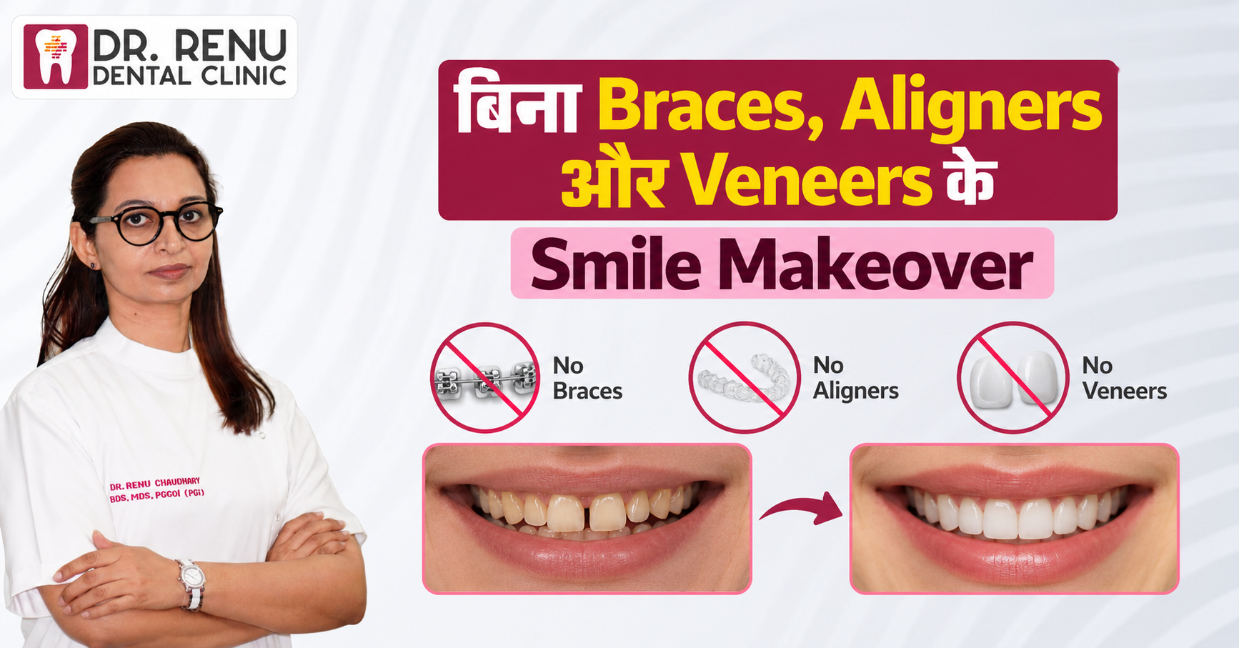 बिना Braces, Aligners और Veneers के Smile Makeover