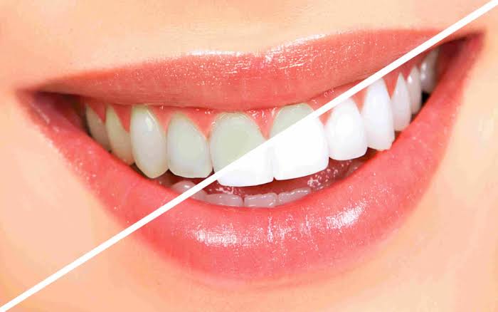 Teeth Whitening – BLANQ